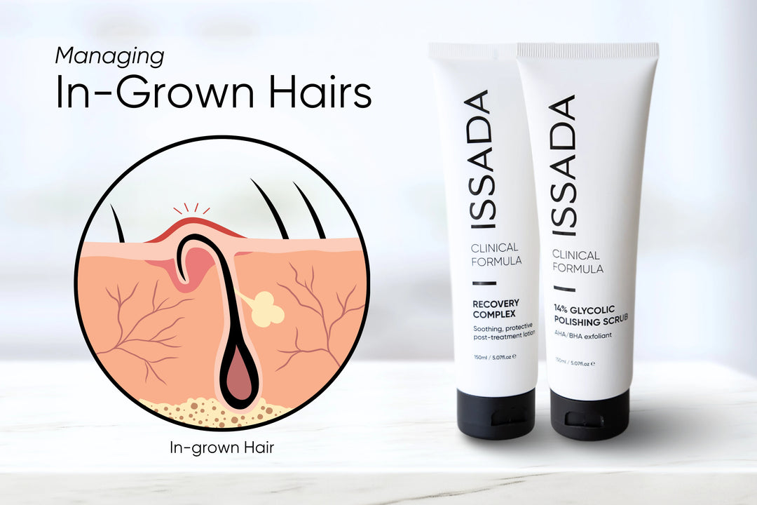 Managing In-Grown Hairs