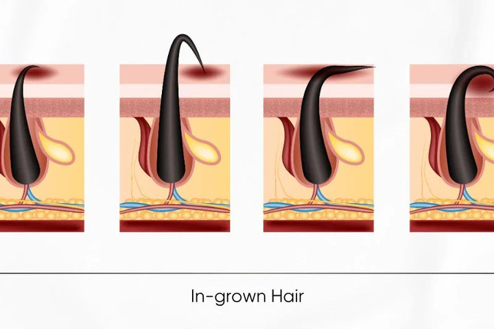 How To Prevent And Manage Ingrown Hairs: A Complete Skincare Guide