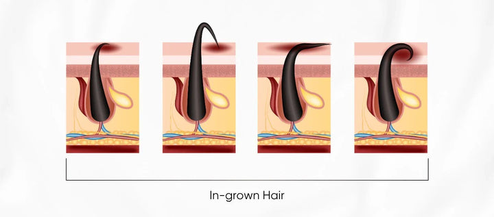 How To Prevent And Manage Ingrown Hairs: A Complete Skincare Guide