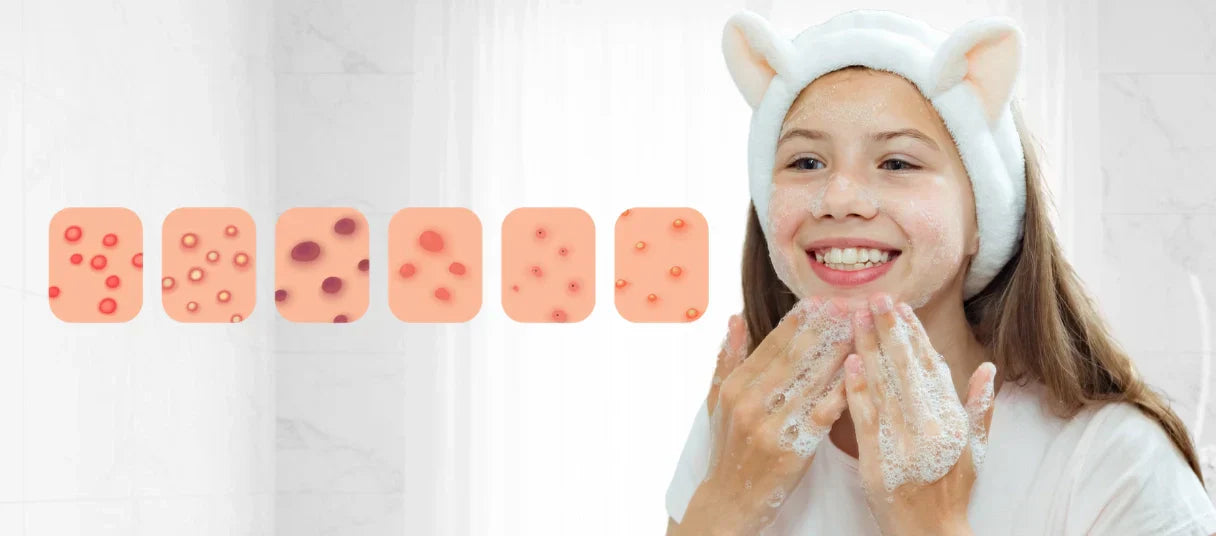 The Ultimate Guide To Pre-Teen & Teen Acne