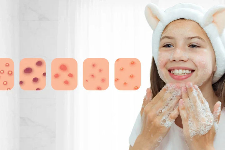 The Ultimate Guide To Pre-Teen & Teen Acne