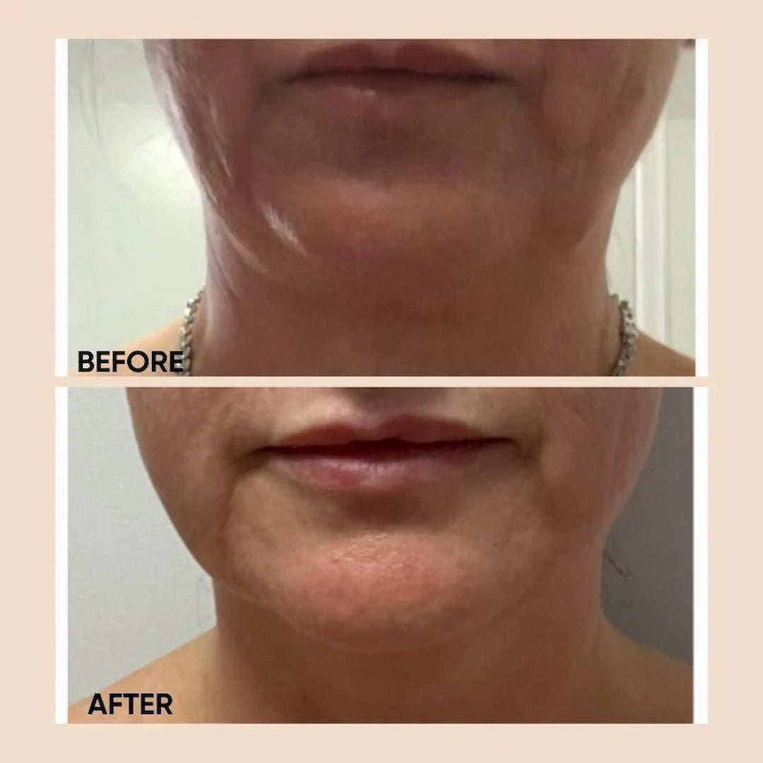 Before and after photo showing visible skin firming and smoother jawline results after using ISSADA Bio-Slim Cellulite Treatment.