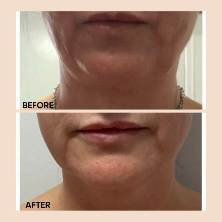 Before and after photo showing visible skin firming and smoother jawline results after using ISSADA Bio-Slim Cellulite Treatment.