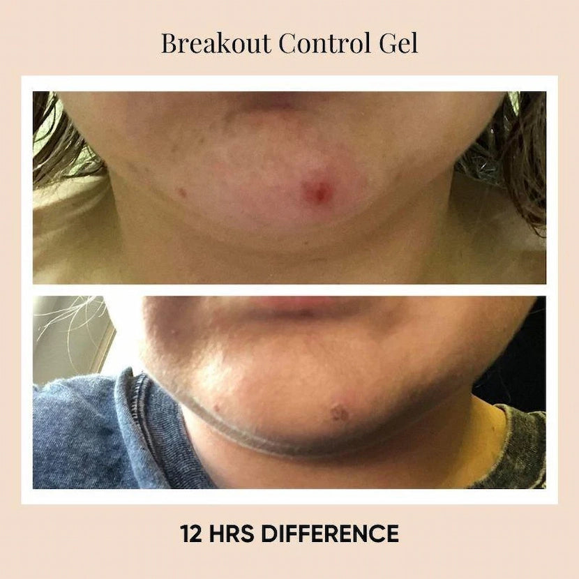 Before and after photo showing 12-hour difference using ISSADA Breakout Control Gel to reduce pimples and redness.