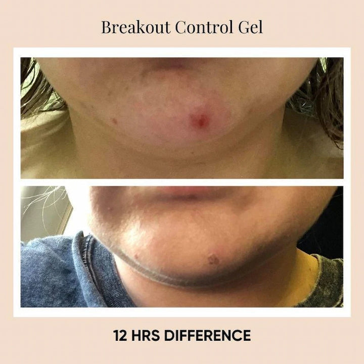 Before and after photo showing 12-hour difference using ISSADA Breakout Control Gel to reduce pimples and redness.