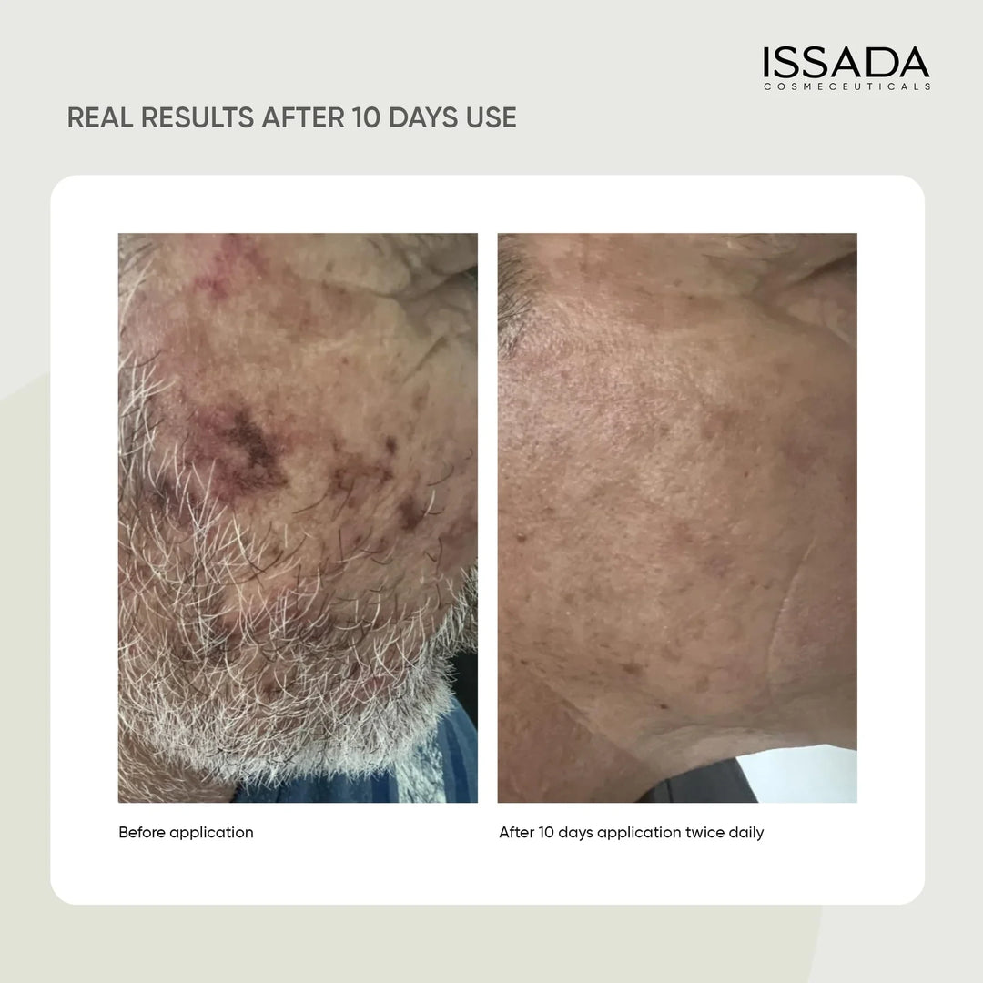 Before and after comparison showing improved skin condition after 10 days of using ISSADA Synbiotic Moisturiser twice daily.
