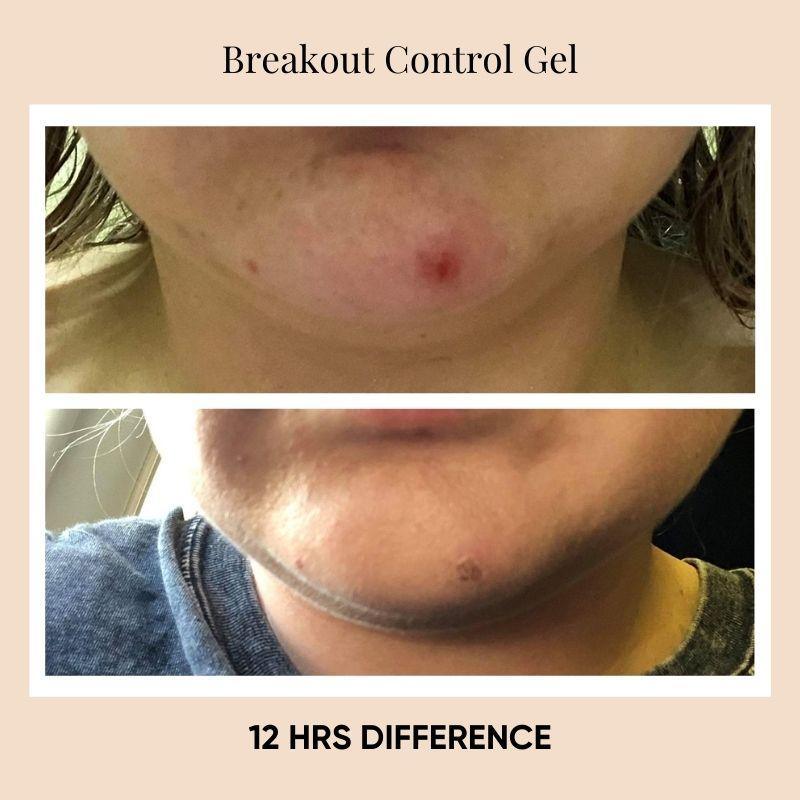 Breakout Control Gel - Issada Mineral Cosmetics & Clinical Skincare